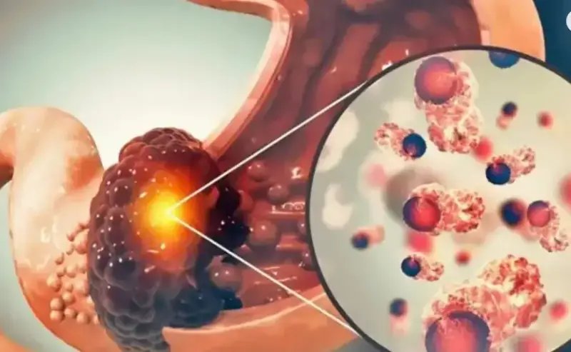 পেটের ক্যান্সারের ৫টি ভয়ংকর ধরণ, যা দ্রুত ছড়িয়ে পড়ে